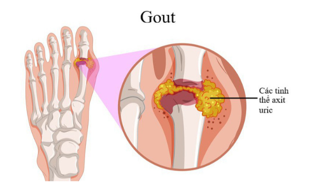 Những biến chứng nguy hiểm khó lường của bệnh Gout